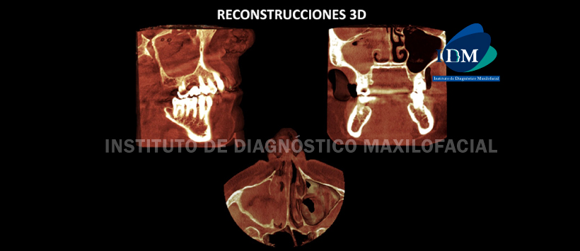 IDM - Reconstrucción 3D - idm