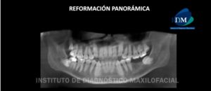 IDM - Reformación Panorámica - idm