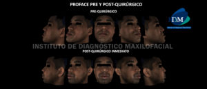 IDM - Proface pre y Post-Quirúrgico - idm