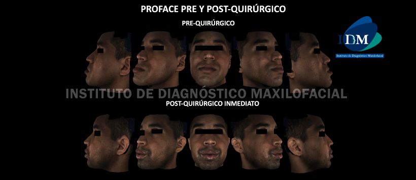 IDM - Proface pre y Post-Quirúrgico - idm