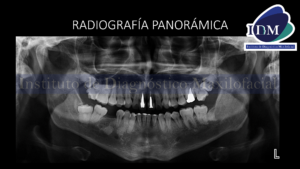 IDM Material de Obturación de Conducto en Seno Maxilar RADIOGRAFIA PANORAMICA IDM IDM IDMPERU IDM