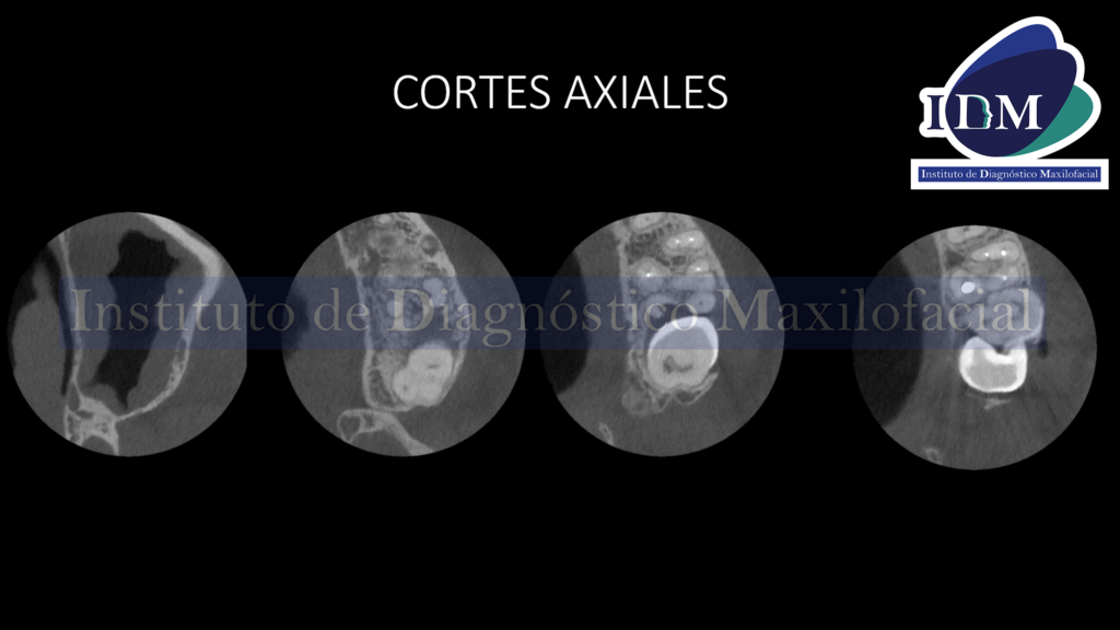 IDM Material de Obturación de Conducto en Seno Maxilar
CORTES AXIALES IDM
IDM IDMPERU IDM CORTES AXIALES
IDM IDMPERU