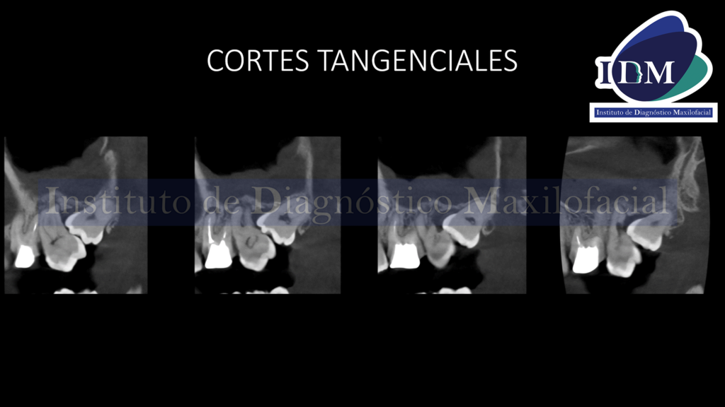 IDM Material de Obturación de Conducto en Seno Maxilar
CORTES TANGENCIALES IDM 
IDM IDMPERU IDM CORTES TANGENCIALES
IDM IDMPERU