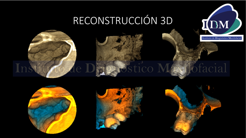 IDM Material de Obturación de Conducto en Seno Maxilar
RECONSTRUCCION 3D IDM 
IDM IDMPERU IDM 
RECONSTRUCCION 3D
IDM IDMPERU