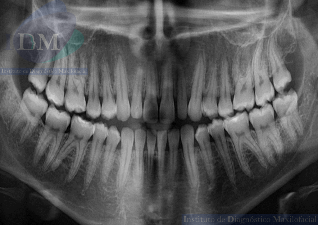 IDM Caso 261 - IDM - AGENESIA DE SENO ESFENOIDAL RADIOGRAFIA PANORAMICA IDM PERU