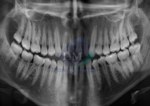 IDM Caso 261 - IDM - AGENESIA DE SENO ESFENOIDAL RADIOGRAFIA PANORAMICA IDM PERÚ