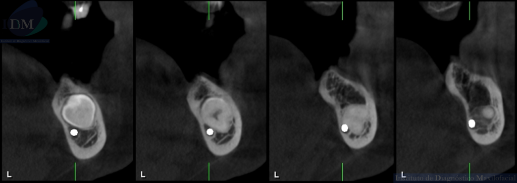 IDM ANQUILOSIS DENTOALVEOLAR CORTES TRANSAXIALES IDM EDUCACIÓN