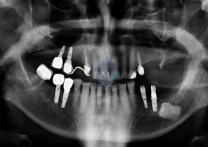 IDM ANQUILOSIS DENTOALVEOLAR RADIOGRAFÍA PANORÁMICA IDM EDUCACIÓN 1