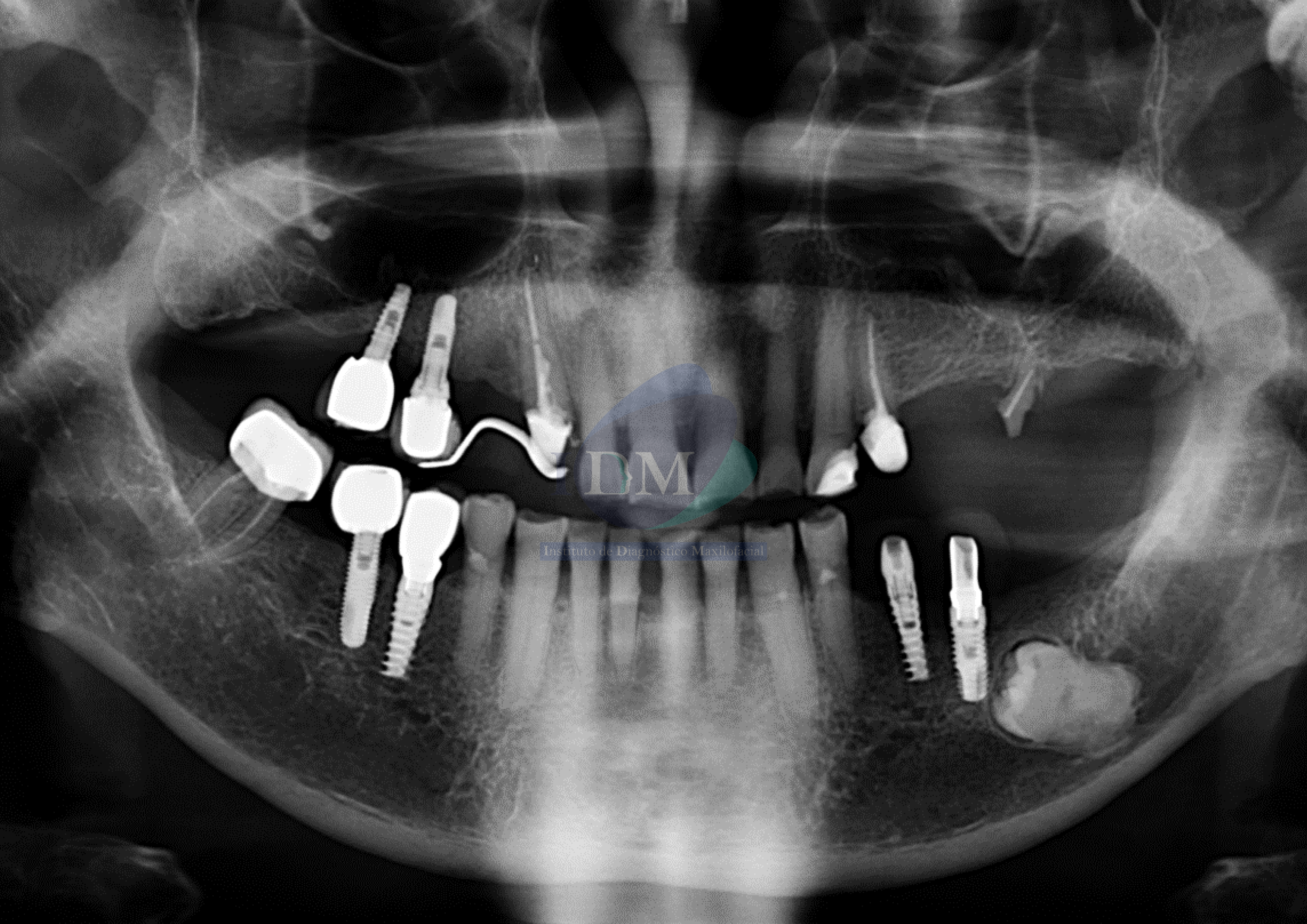 IDM ANQUILOSIS DENTOALVEOLAR RADIOGRAFÍA PANORÁMICA IDM EDUCACIÓN 1