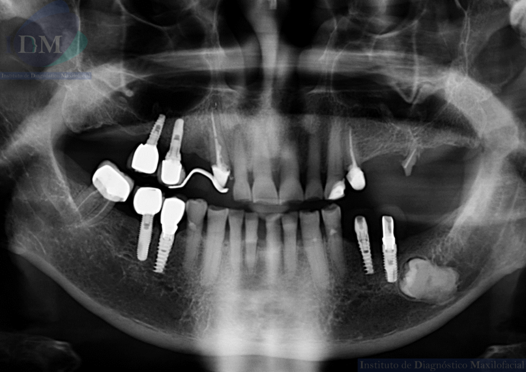 IDM ANQUILOSIS DENTOALVEOLAR RADIOGRAFÍA PANORÁMICA IDM EDUCACIÓN 2