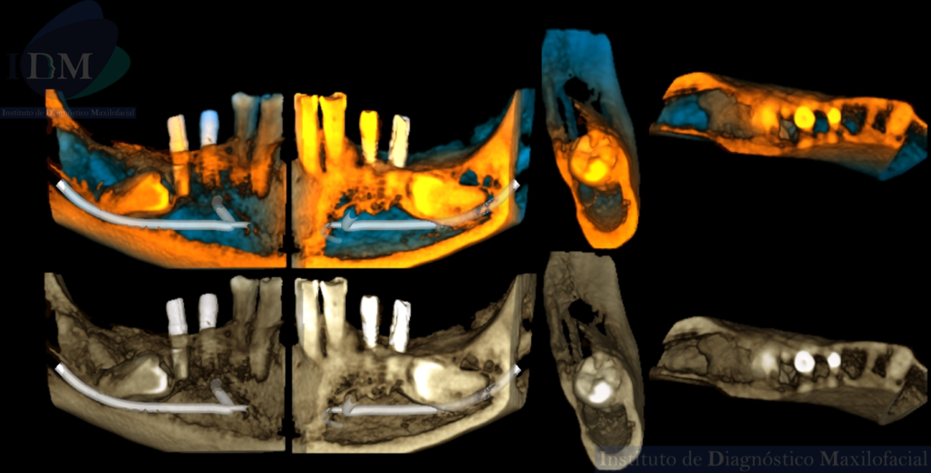 IDM ANQUILOSIS DENTOALVEOLAR RECONSTRUCCION 3D IDM EDUCACIÓN