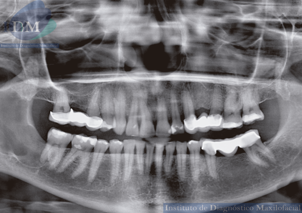 IDM CASO QUERATOQUISTE ODONTOGENICO MANDIBULAR IDM EDUCACION RADIOGRAFIA PANORAMICA