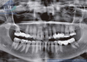 IDM CASO QUERATOQUISTE ODONTOGENICO MANDIBULAR IDM EDUCACION RADIOGRAFIA PANORAMICA
