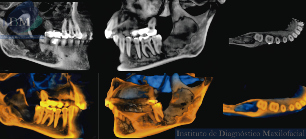 IDM CASO QUERATOQUISTE ODONTOGENICO MANDIBULAR IDM EDUCACION RECONSTRUCCION 3D