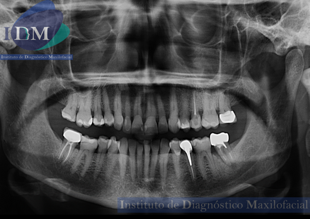 radiografia panoramica idm caso 259 idm