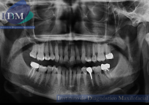 radiografia panoramica idm caso 259 idm