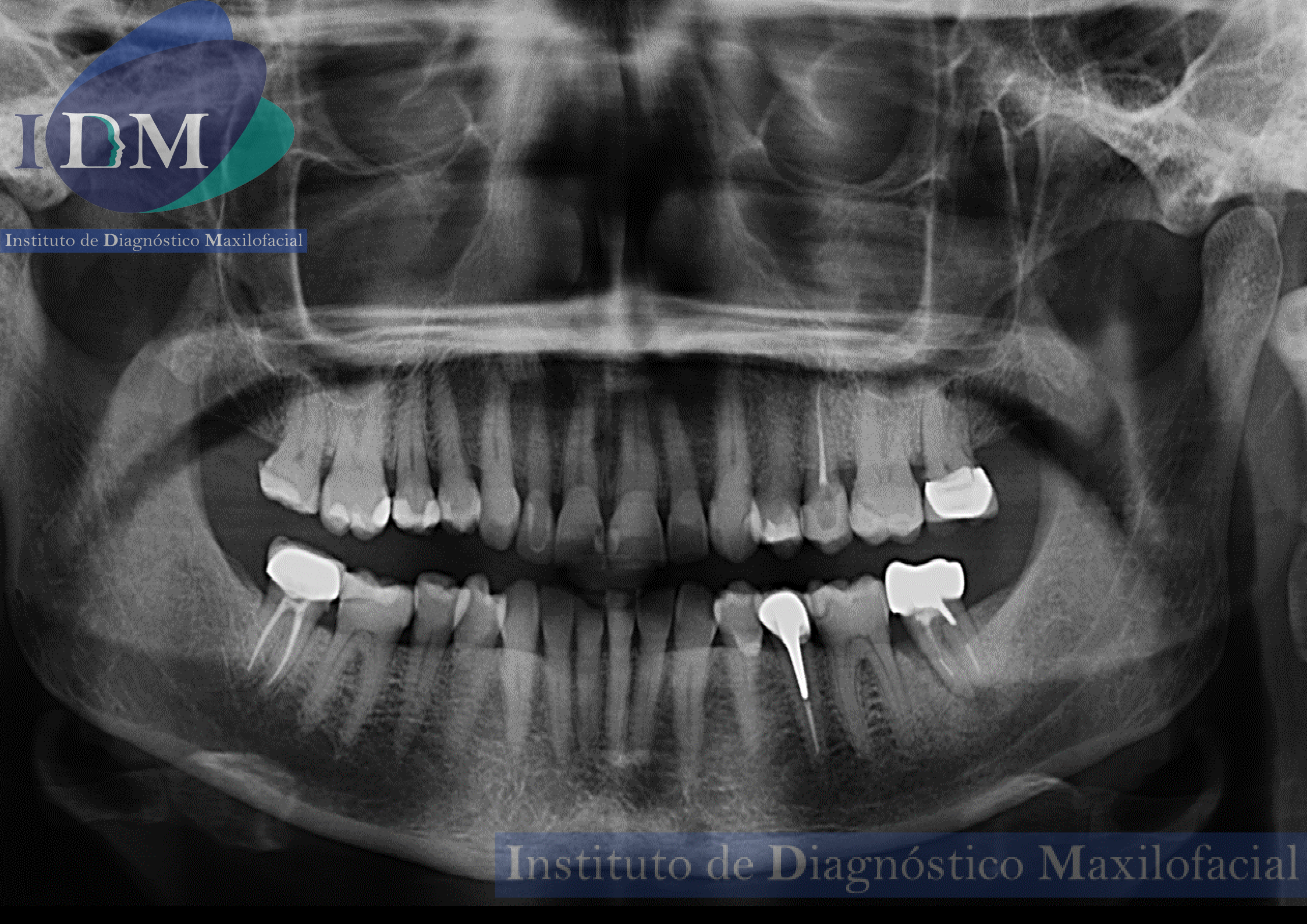radiografia panoramica idm caso 259 idm