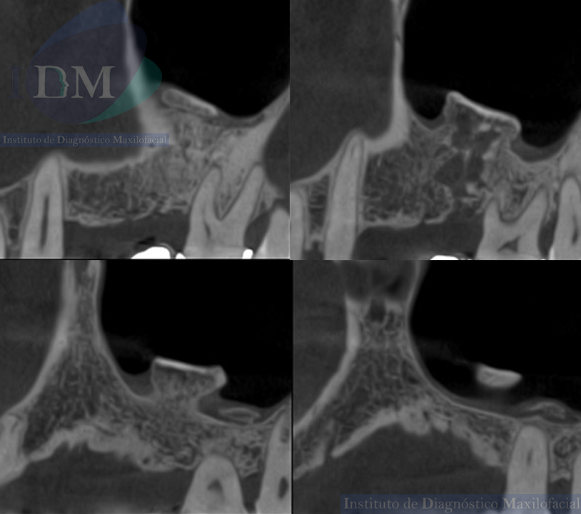 CASO 265 IDM – Osteogénesis reactiva en el seno maxilar cortes tangenciales IDM PERÚ 2