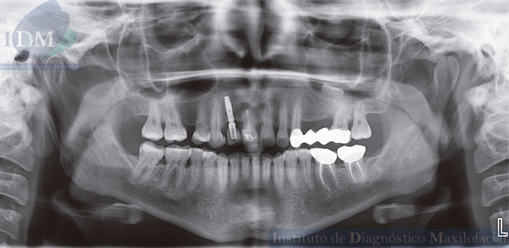 CASO 265 IDM – Osteogénesis reactiva en el seno maxilar panorámica 01 IDM PERÚ