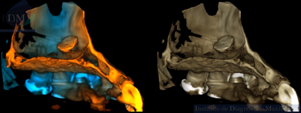 CASO 265 IDM – Osteogénesis reactiva en el seno maxilar reconstrucción 3d 2 IDM PERÚ