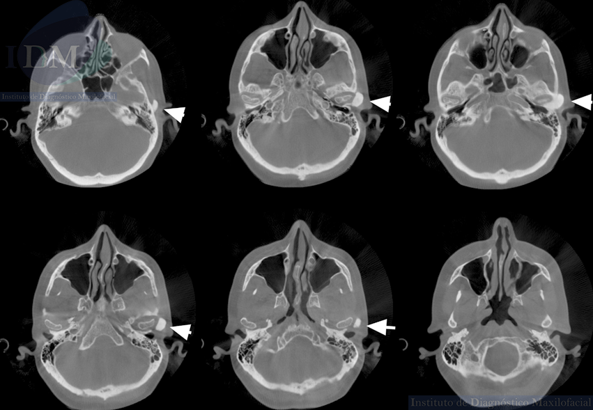 CASO 266 IDM – OSTEOMA INFRATEMPORAL Cortes Axiales