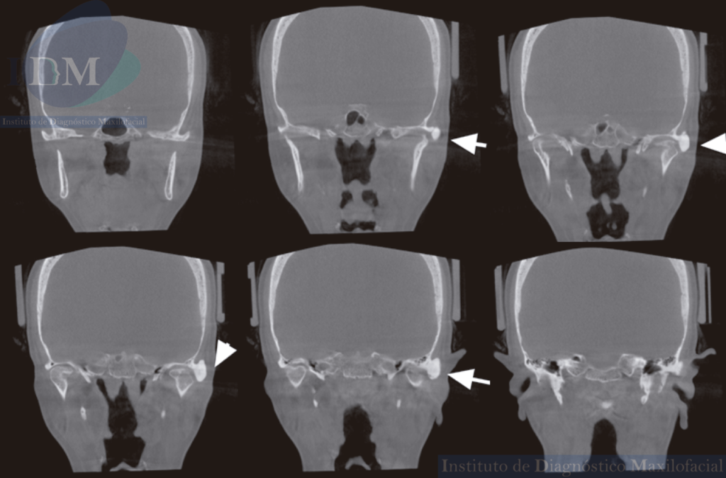 CASO 266 IDM – OSTEOMA INFRATEMPORAL Cortes Coronales