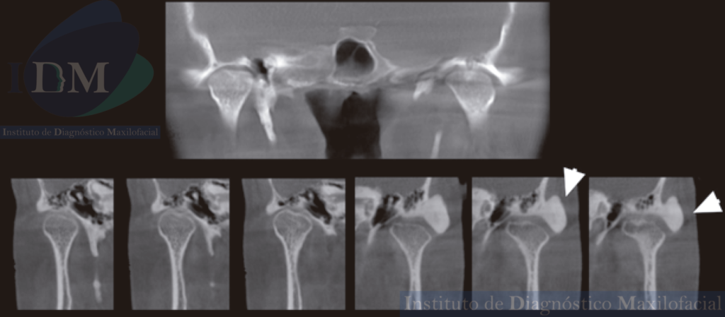 CASO 266 IDM – OSTEOMA INFRATEMPORAL Cortes Coronales ATM boca cerrada