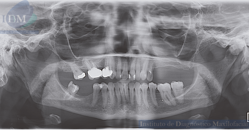 CASO 266 IDM – OSTEOMA INFRATEMPORAL PANORAMICA 2