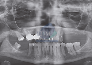CASO 266 IDM – OSTEOMA INFRATEMPORAL PANORAMICA