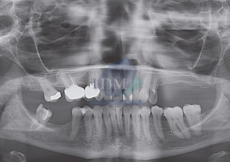 CASO 266 IDM – OSTEOMA INFRATEMPORAL PANORAMICA