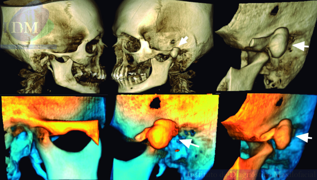 CASO 266 IDM – OSTEOMA INFRATEMPORAL Reconstrucción 3D