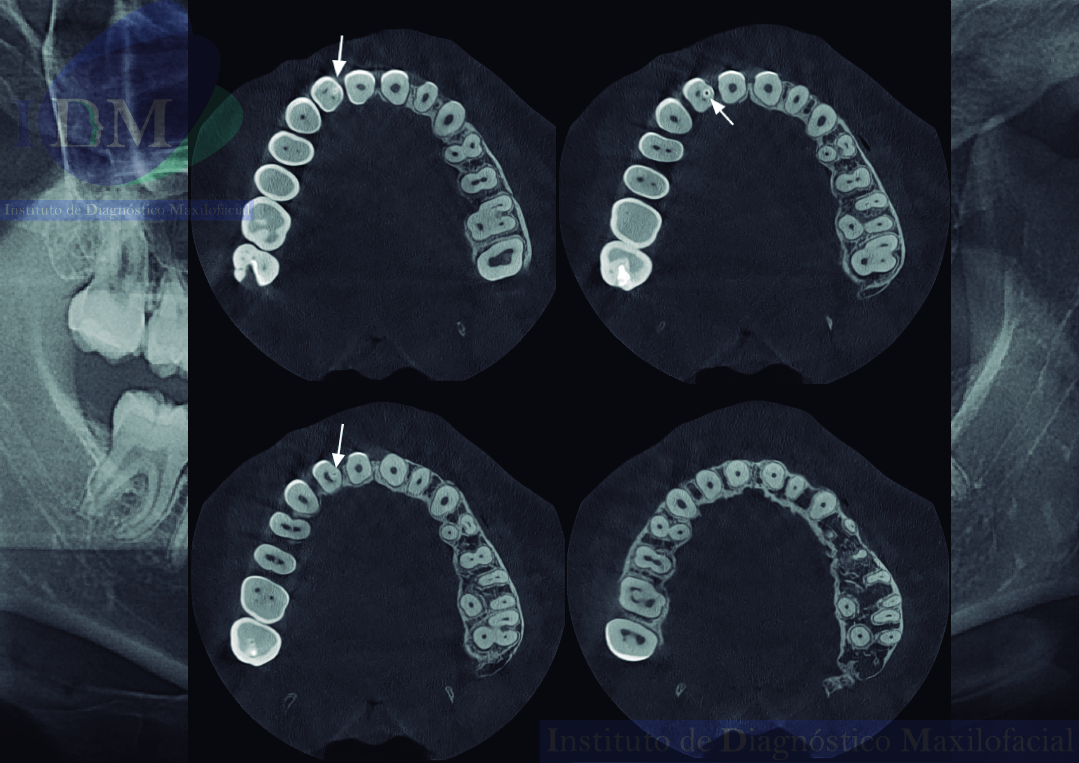 Imagen de caso de estudio de cortes axiales, una herramienta esencial para el diagnóstico odontológico. Vista panorámica IDM de alta resolución para análisis dental detallado. IDM Peru, expertos en tecnología dental, ofrecen soluciones avanzadas para la atención odontológica. IDM Peru Caso 263 Cortes axiales Vista Panorámica IDM Diagnóstico odontológico Análisis dental Odontología Tecnología dental Atención odontológica Anatomía dental