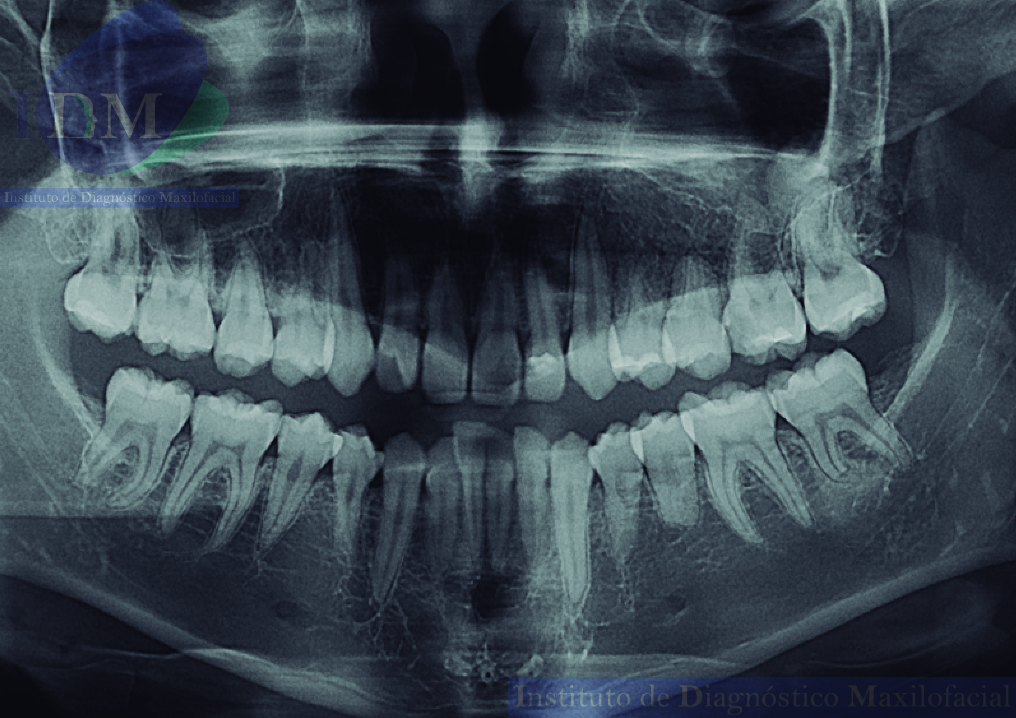 Imagen de caso de estudio de Dens Invaginatus, una anomalía dental rara. Vista panorámica IDM de alta resolución para diagnóstico odontológico preciso. IDM Peru, expertos en tecnología dental, ofrecen soluciones avanzadas para la atención odontológica IDM Peru Dens Invaginatus Vista Panorámica IDM Caso 263 Odontología Tecnología dental Atención odontológica Diagnóstico odontológico Anomalía dental Condición dental rara