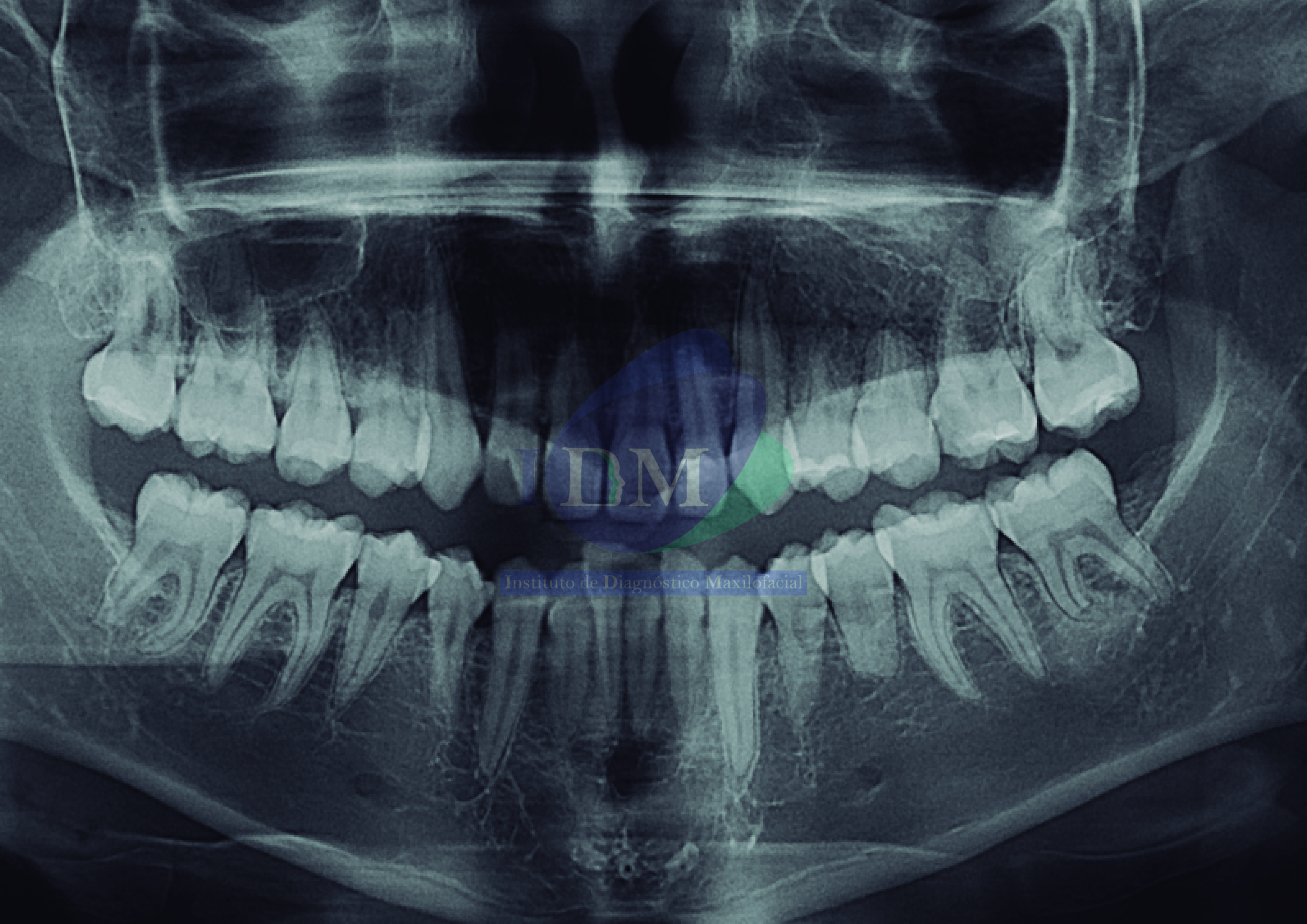 Imagen de caso de estudio de Dens Invaginatus, una anomalía dental rara. Vista panorámica IDM de alta resolución para diagnóstico odontológico preciso. IDM Peru, expertos en tecnología dental, ofrecen soluciones avanzadas para la atención odontológica IDM Peru Dens Invaginatus Vista Panorámica IDM Caso 263 Odontología Tecnología dental Atención odontológica Diagnóstico odontológico Anomalía dental Condición dental rara