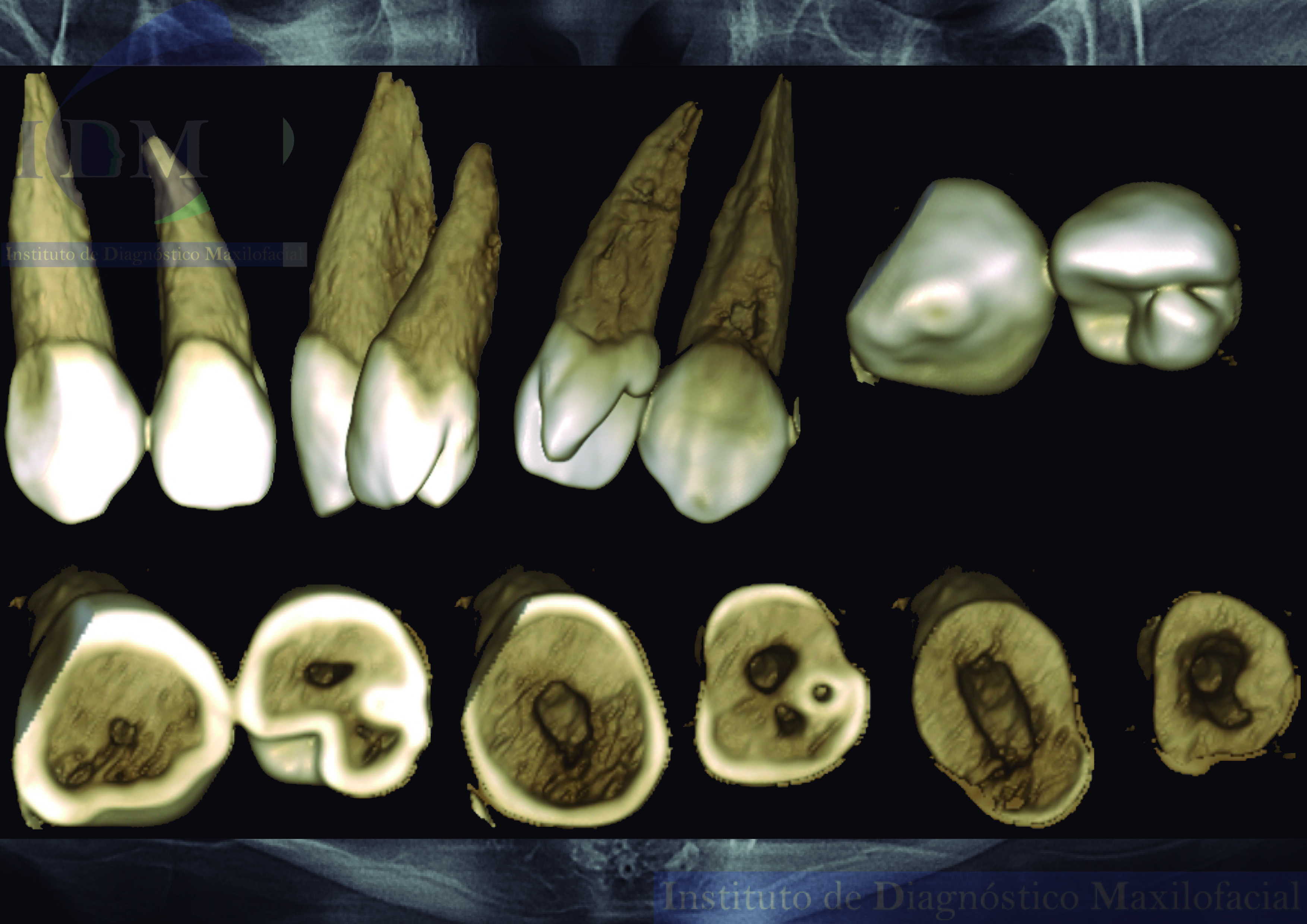 Imagen de caso de estudio de reconstrucción 3D, una herramienta esencial para el diagnóstico odontológico. Vista panorámica IDM de alta resolución para análisis dental detallado en 3D. IDM Peru, expertos en tecnología dental, ofrecen soluciones avanzadas para la atención odontológica, incluyendo la reconstrucción 3D para un diagnóstico más preciso. IDM Peru Caso 263 Reconstrucción 3D Vista Panorámica IDM Diagnóstico odontológico Análisis dental Odontología Tecnología dental Atención odontológica Anatomía dental Diagnóstico preciso