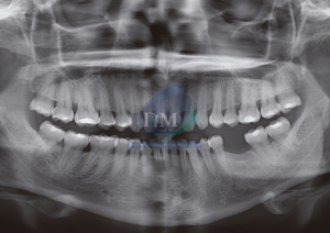 caso 264 BIFURCACION DEL CONDUCTO DENTARIO INFERIOR Y AGUJERO MENTONIANO RX PANORAMICA 01