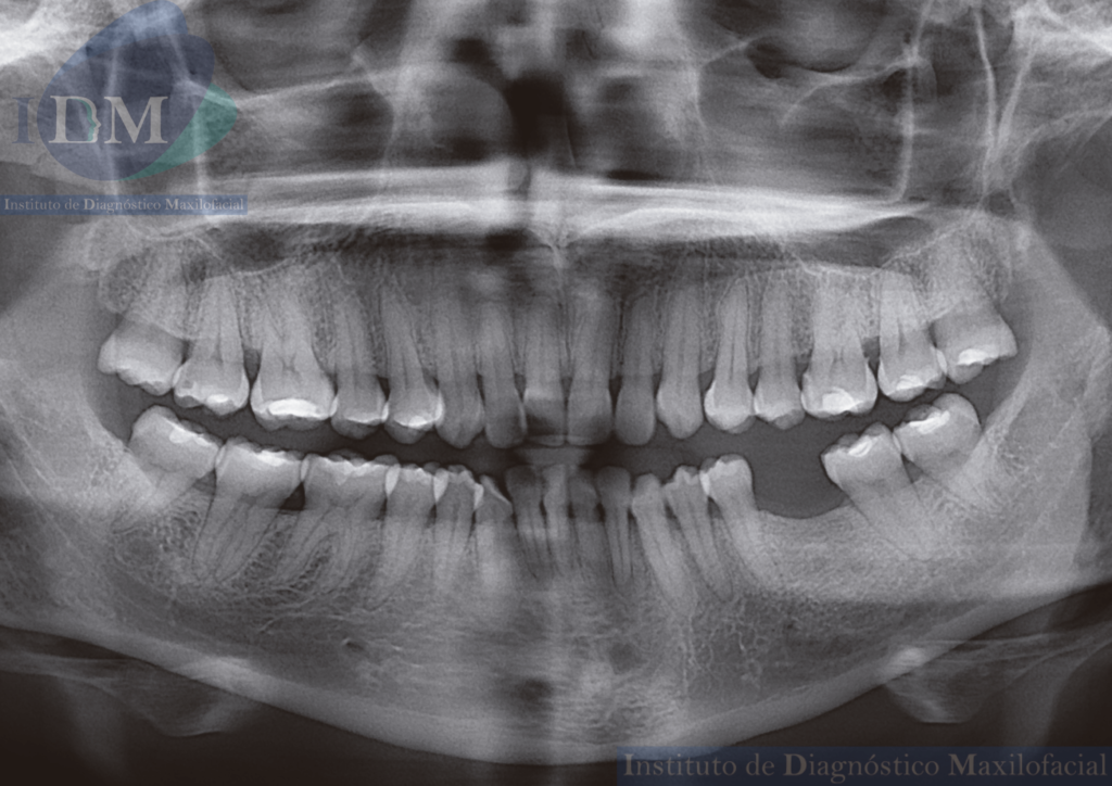 caso 264 BIFURCACION DEL CONDUCTO DENTARIO INFERIOR Y AGUJERO MENTONIANO RX PANORAMICA 02