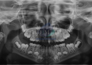 CASO 268 - MESIODENS DOBLE RADIOGRAFIA PANORAMICA 01 IDM