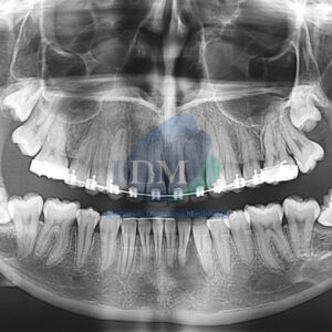CASO-276-ODONTOMA-COMPUESTO-IDM-PERU-RADIOGRAFIA-PANORAMICA-1