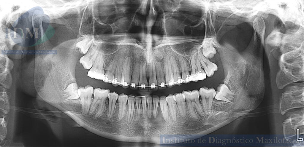 CASO 276 IDM ODONTOMA COMPUESTO IDM PERU RADIOGRAFIA PANORAMICA 2