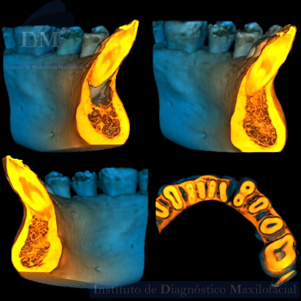 CASO 276 IDM ODONTOMA COMPUESTO IDM PERU RECONSTRUCCION 3D