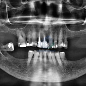 CASO-277-SUPERNUMERARIO-EN-PALADAR-DURO-CON-AMELOCLASIA-PRESENTE-IDM-PERU-RADIOGRAFIA-PANORAMICA-1