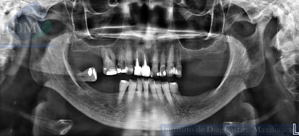 CASO 277 IDM SUPERNUMERARIO EN PALADAR DURO CON AMELOCLASIA PRESENTE IDM PERU RADIOGRAFIA PANORAMICA 2
