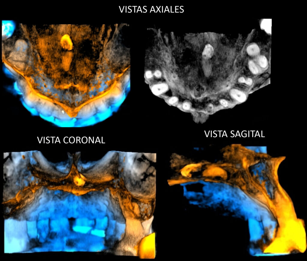 CASO 277 IDM SUPERNUMERARIO EN PALADAR DURO CON AMELOCLASIA PRESENTE IDM PERU RECONSTRUCCION 3D