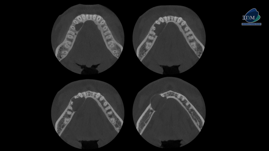 CASO 279 AMELOBLASTOMA UNIQUISTICO IDM PERU CORTES AXIALES