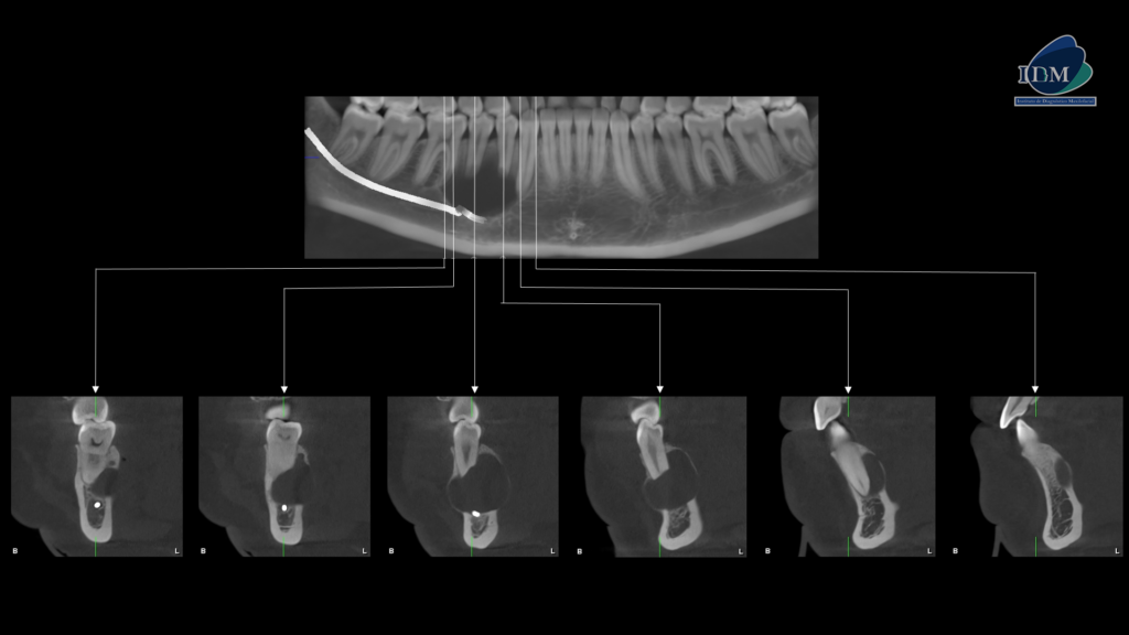 CASO 279 AMELOBLASTOMA UNIQUISTICO IDM PERU CORTES TRANSAXIALES