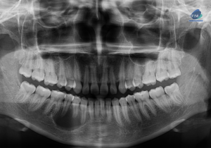 CASO 279 AMELOBLASTOMA UNIQUISTICO IDM PERU PANORAMICA