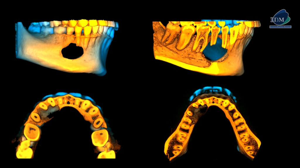 CASO 279 AMELOBLASTOMA UNIQUISTICO IDM PERU RECONSTRUCCION 3D