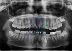 Caso 267 - IDM - Odontoma complejo Radiografia panoramica 01