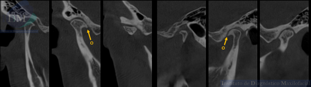 Caso 269 - Trastorno degenerativo de ATM (Osteoartritis) IDM cortes Sagitales